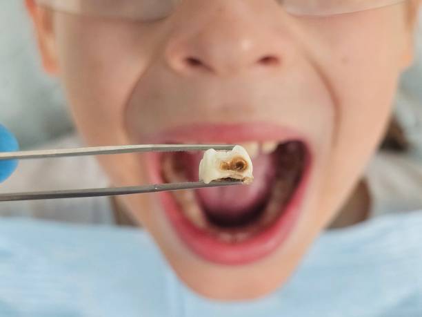 Best Knocked-Out Tooth (Avulsed Tooth) Treatment in Lafayette, GA